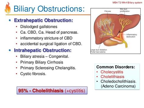 Biliary Obstruction: Causes, Symptoms, Treatment,。